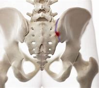 Image result for Sacroiliac Joint Fusion