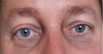 Image result for Dark Circles Under Eyes
