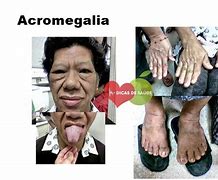 Image result for acrokegalia