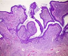 Image result for Verrucous Congenital Nevus Pathology
