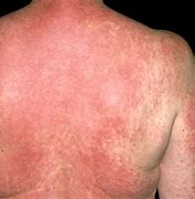 Image result for Allergic Drug Reaction Rash