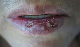 Image result for Actinic Cheilitis Lip