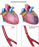 Image result for Heart Attack Photos