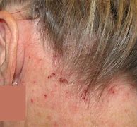 Image result for Atopic Dermatitis Images