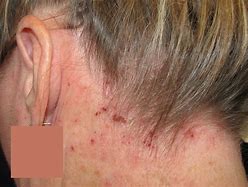 Image result for Eczema On the Scalp