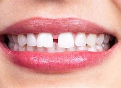 Image result for diastema