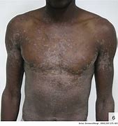 Image result for Syphilis Picturs