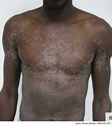 Image result for Syphilis Patient