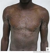Image result for Pustular Syphilis