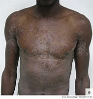 Image result for Syphilis Scars