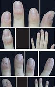 Image result for Periungual Skin Breakdown