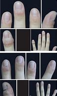 Image result for Periungual Skin Lesions