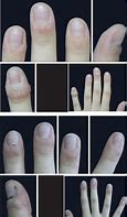Image result for Periungual Wart Removal