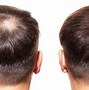 Image result for Minoxidil Before and After