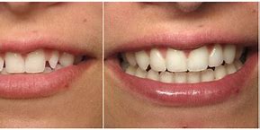 Image result for Lateral Incisor Build Up