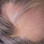 Image result for alopevia