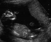 Image result for Anencephaly