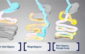 Image result for Gastric Bypass Surgery Omega Loop
