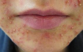 Image result for Acne around Mouth