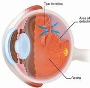 Image result for Macula On Retinal Detachment