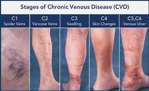 Image result for Types of Varicose Veins