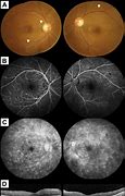 Image result for Syphilis Oct Retina