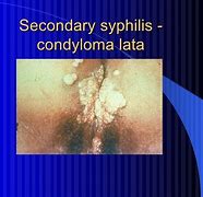 Image result for CDC Condyloma