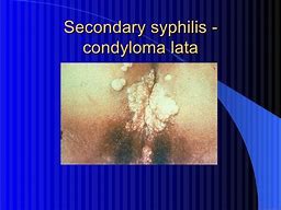 Image result for Condyloma STD