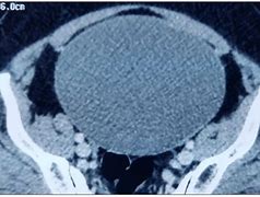 Image result for Ovarian Cyst CT Scan