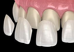 Image result for Best Teeth Veneers