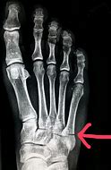 Image result for Broken Foot Jones Fracture