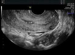 Image result for Cervical Infiltrations Ultrasound
