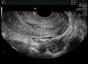 Image result for Cervical Cancer Ultrasound