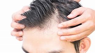 Image result for Balding in Teens