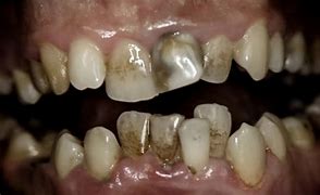 Image result for What Do Rotten Teeth Look Like