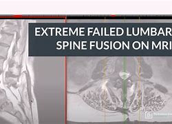 Image result for Spinal Fusion Failure