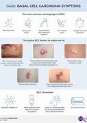 Image result for Basal Cell Carcinoma Diagram