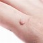 Image result for How to Get Rid of Warts in a Week
