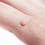 Image result for Flat Warts On Arm