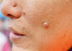 Image result for Remove Warts On Face