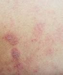 Image result for Eczema Cancer