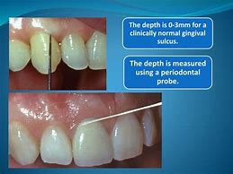 Image result for Macroscopic Features of Gingiva