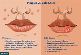 Image result for Cold Sore vs Pimple