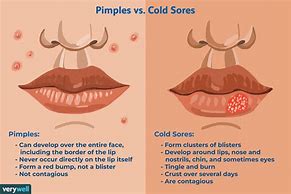 Image result for Cold Sore above Lip