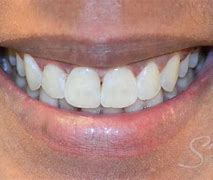 Image result for Before and After Smile Portland