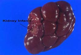Image result for Renal Lesions On Kidney