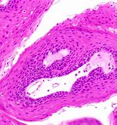Image result for Squamous Papilloma Skin Gross Appearance