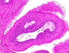 Image result for Subungual Papilloma