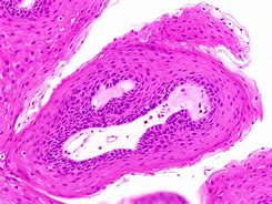 Image result for Papilloma of Skin