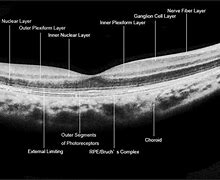 Image result for Oct Retinal Layers